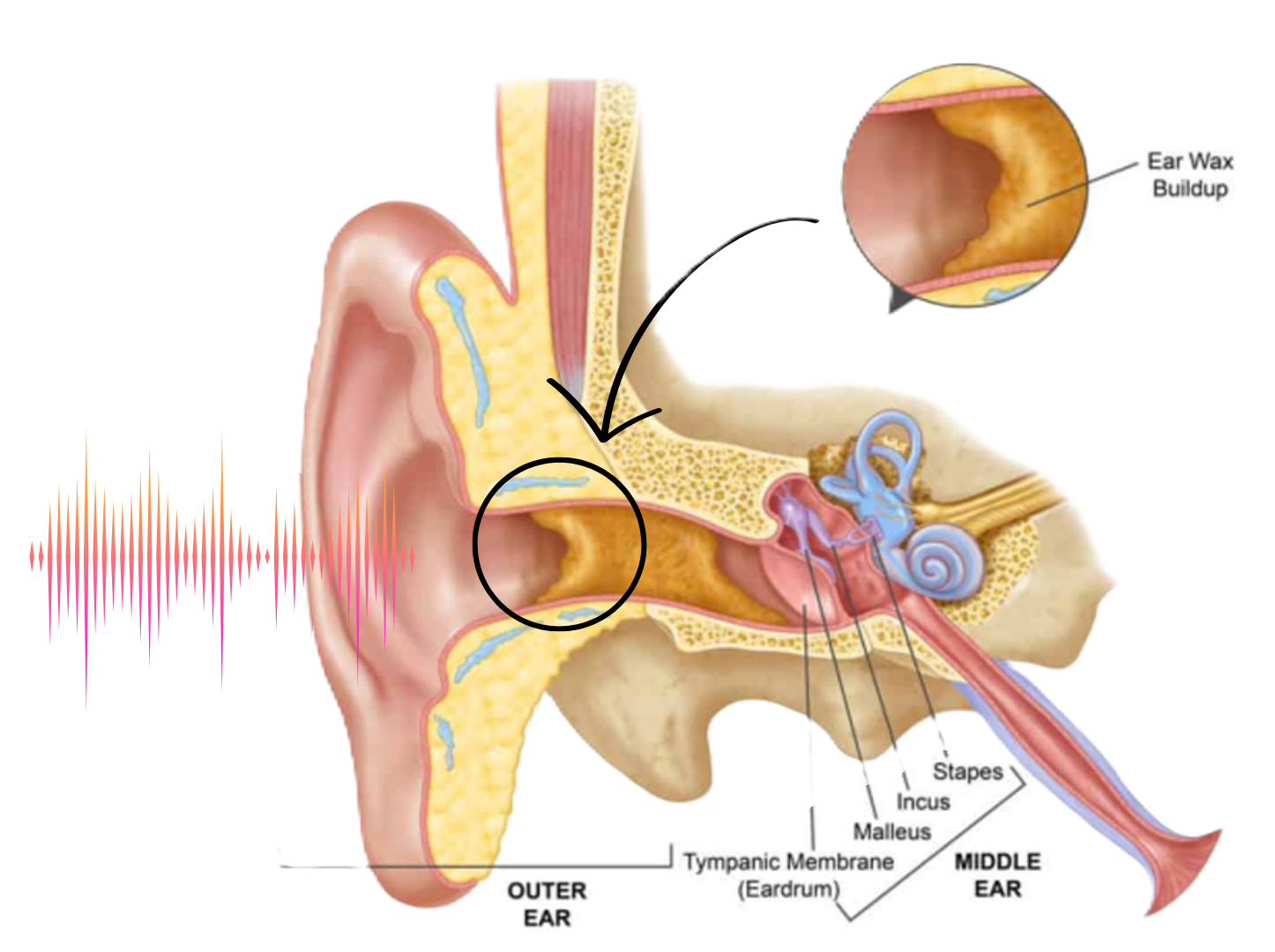 Web In Ear Hearing Aid Program - Clear Hearing
